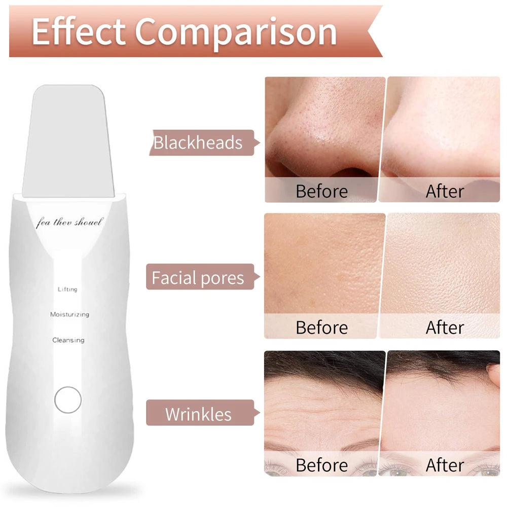 Ultrasonic Skin Scraper: Deep Clean & Blackhead Remover